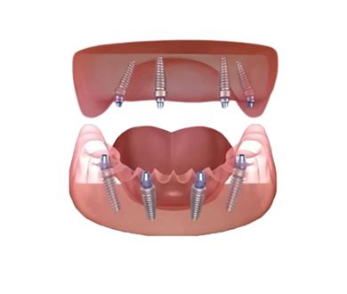 dental implants cost in cambodia|Dental Implant Clinics in Cambodia .